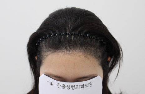 더헤어라인성형외과의원 이미지