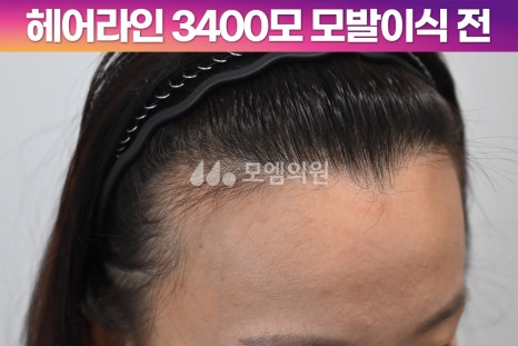 중앙헤어라인 이미지
