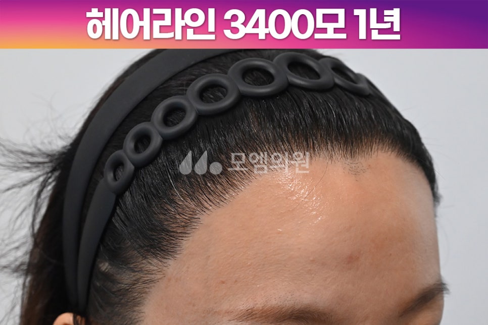 헤어라인 이미지