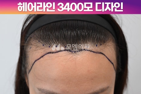 중앙헤어라인 이미지