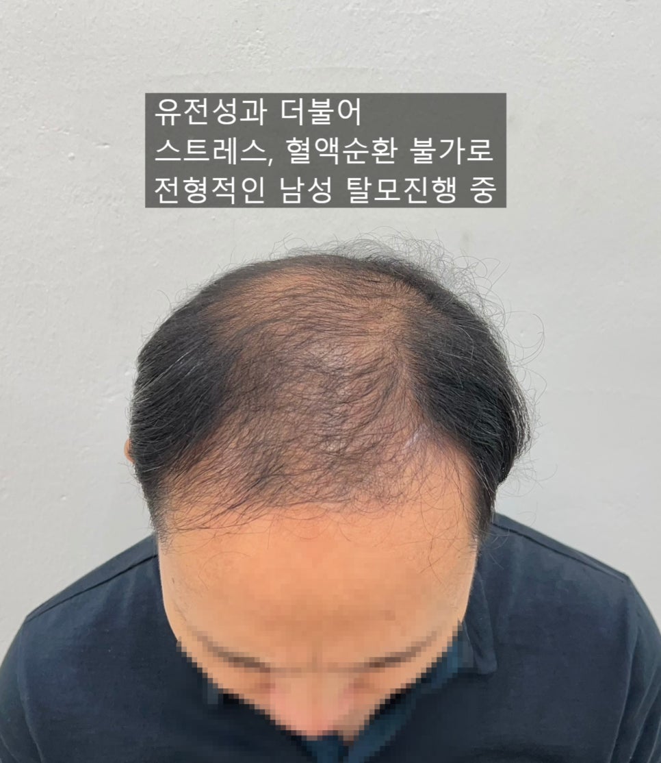 초이스칼프 이미지