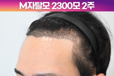 헤어라인 이미지