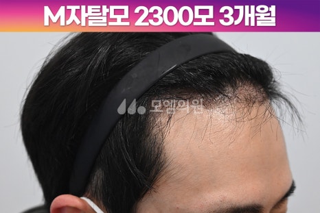 헤어라인 이미지