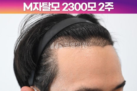 헤어라인 이미지