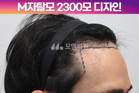 헤어라인 이미지