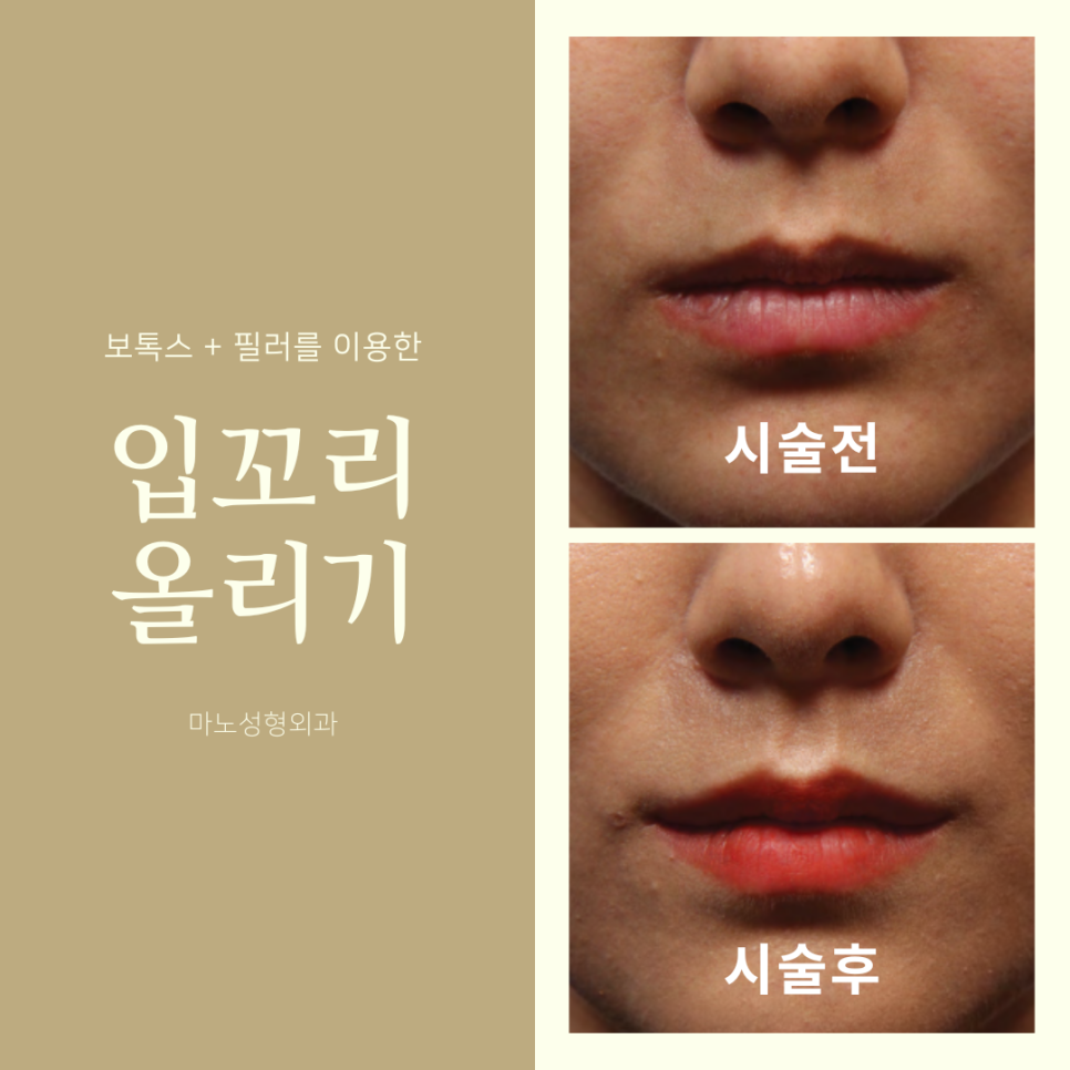 입꼬리 리프팅 개념과 방법 및 전후 비교 사례 알아보기 : 네이버 블로그