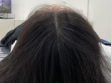 림스칼프 이미지