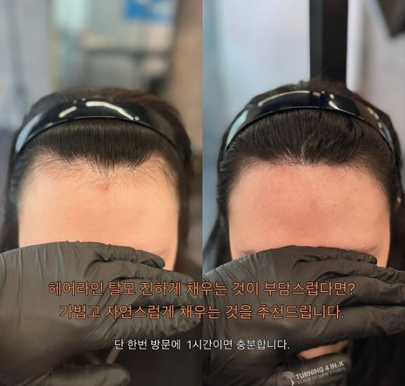 헤어라인 이미지