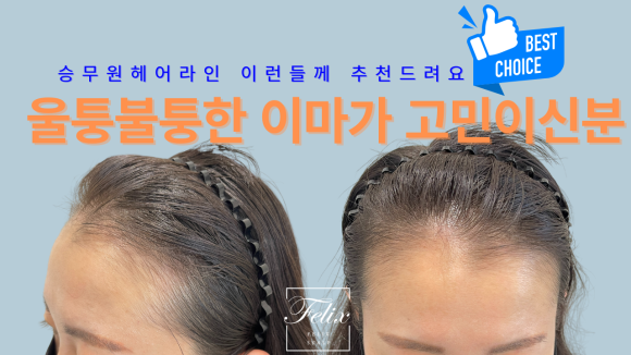 헤어라인 이미지