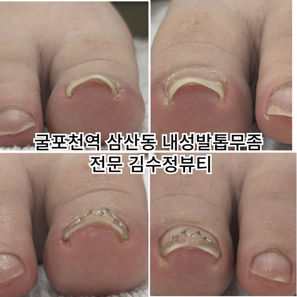 내성발톱발톱무좀관리김수정뷰티 이미지