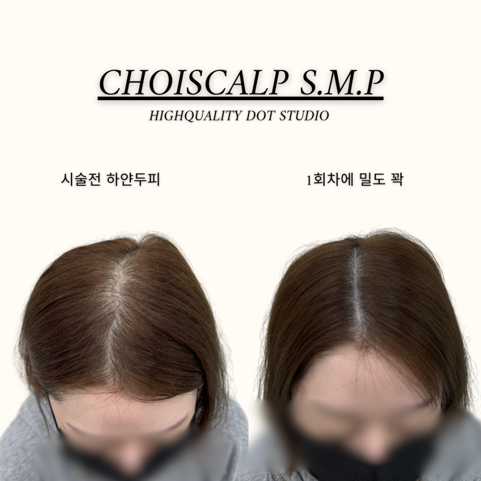 초이스칼프 이미지