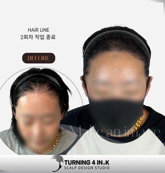 헤어라인 이미지