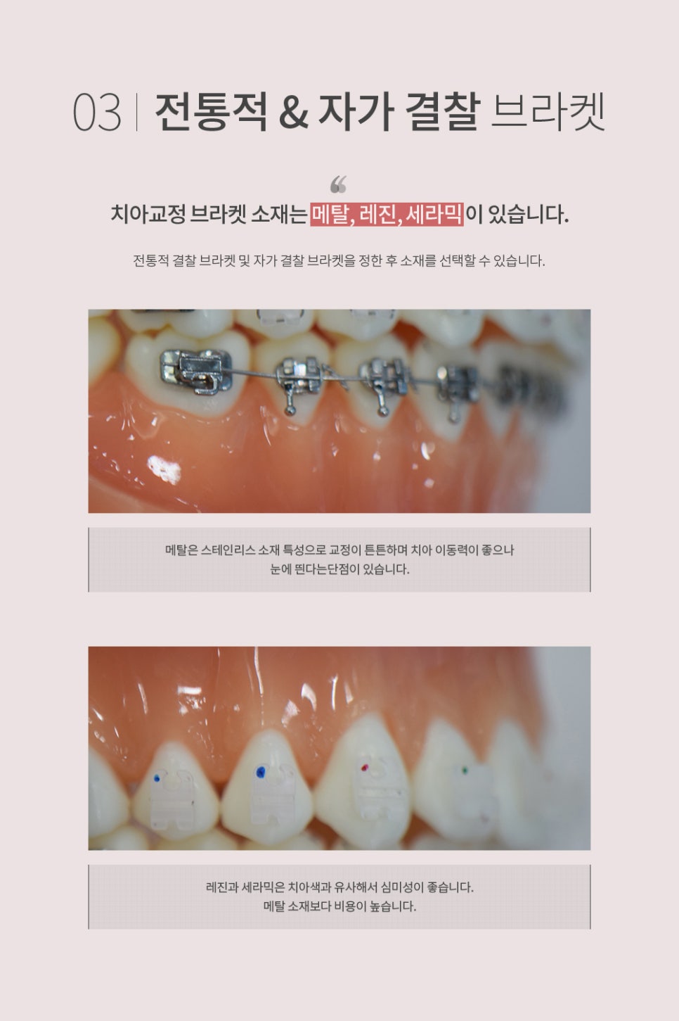 심플교정 이미지