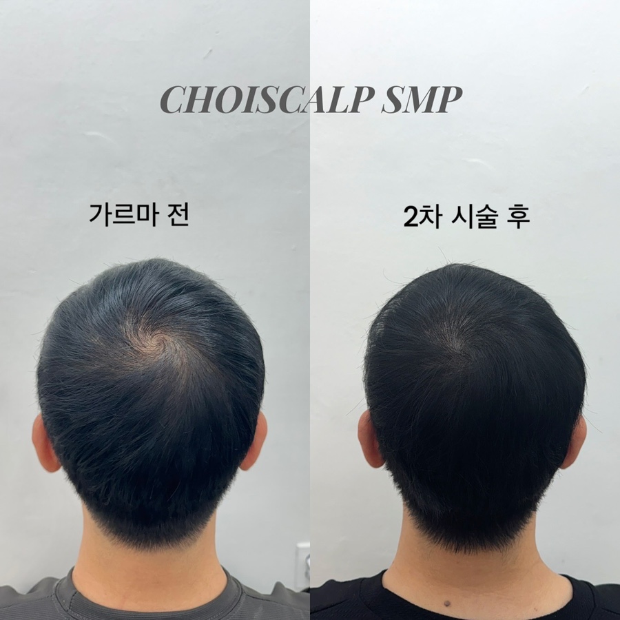 초이스칼프 이미지