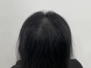 림스칼프 이미지