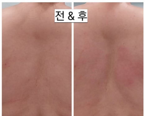 바른선 테라피 이미지