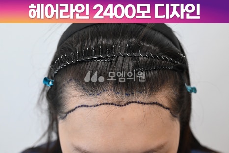 중앙헤어라인 이미지