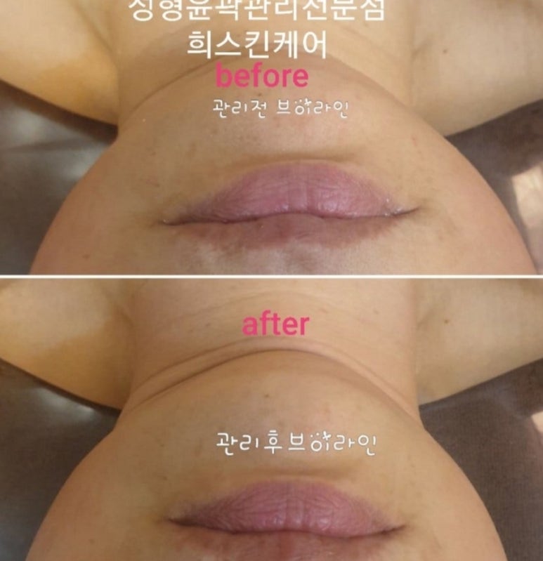 희스킨 이미지