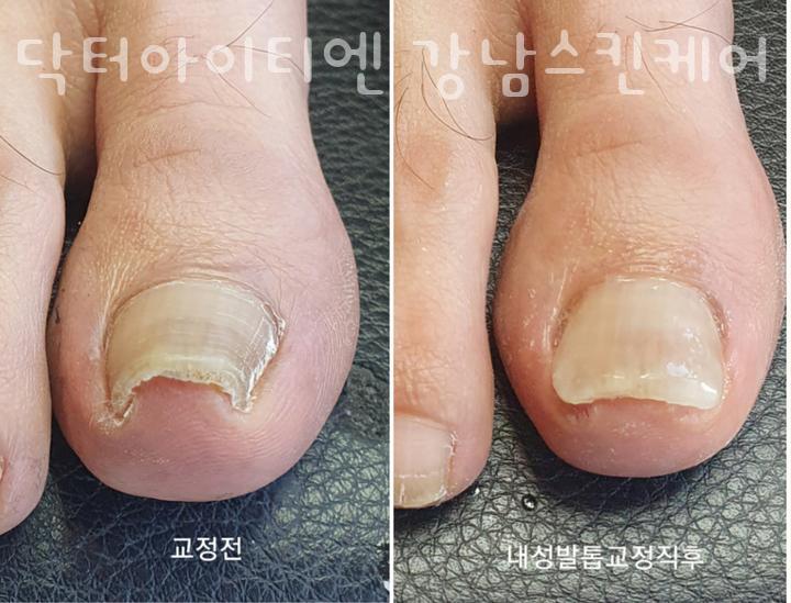 케어네일 이미지
