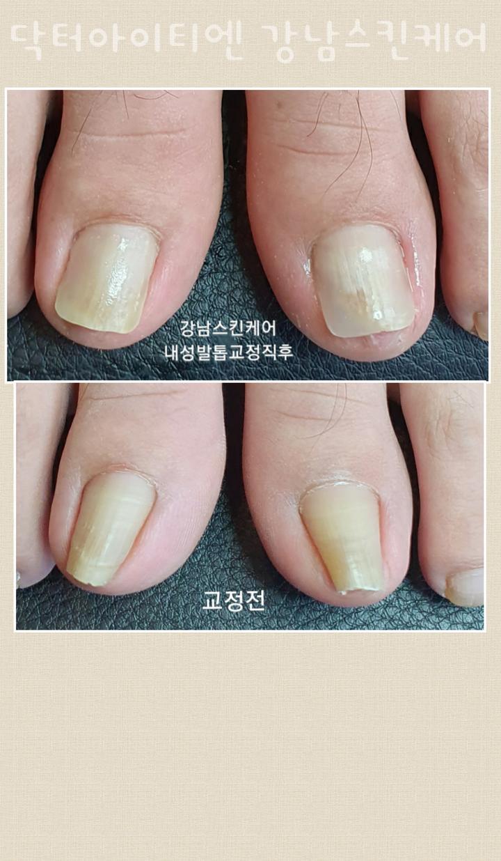 케어네일 이미지