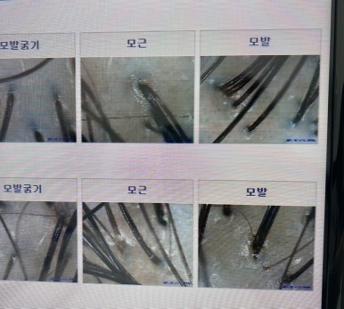 모리온두피탈모 이미지