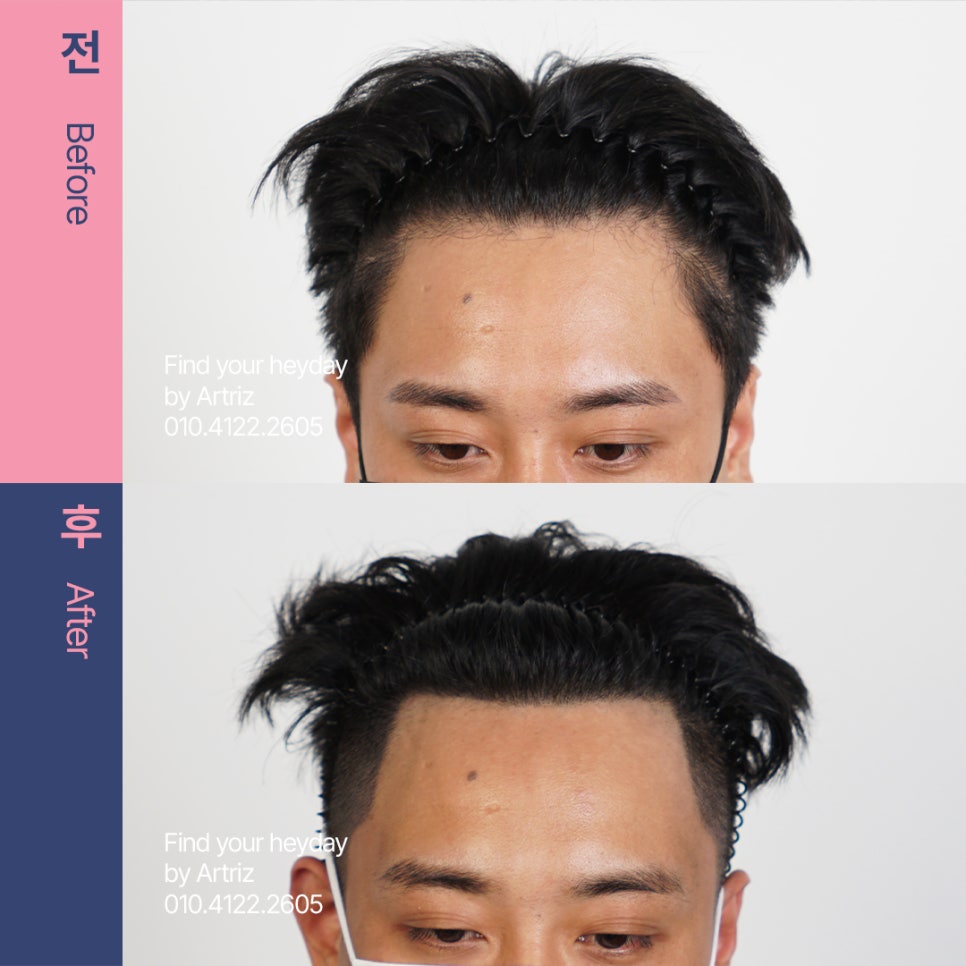 미미헤어라인 이미지