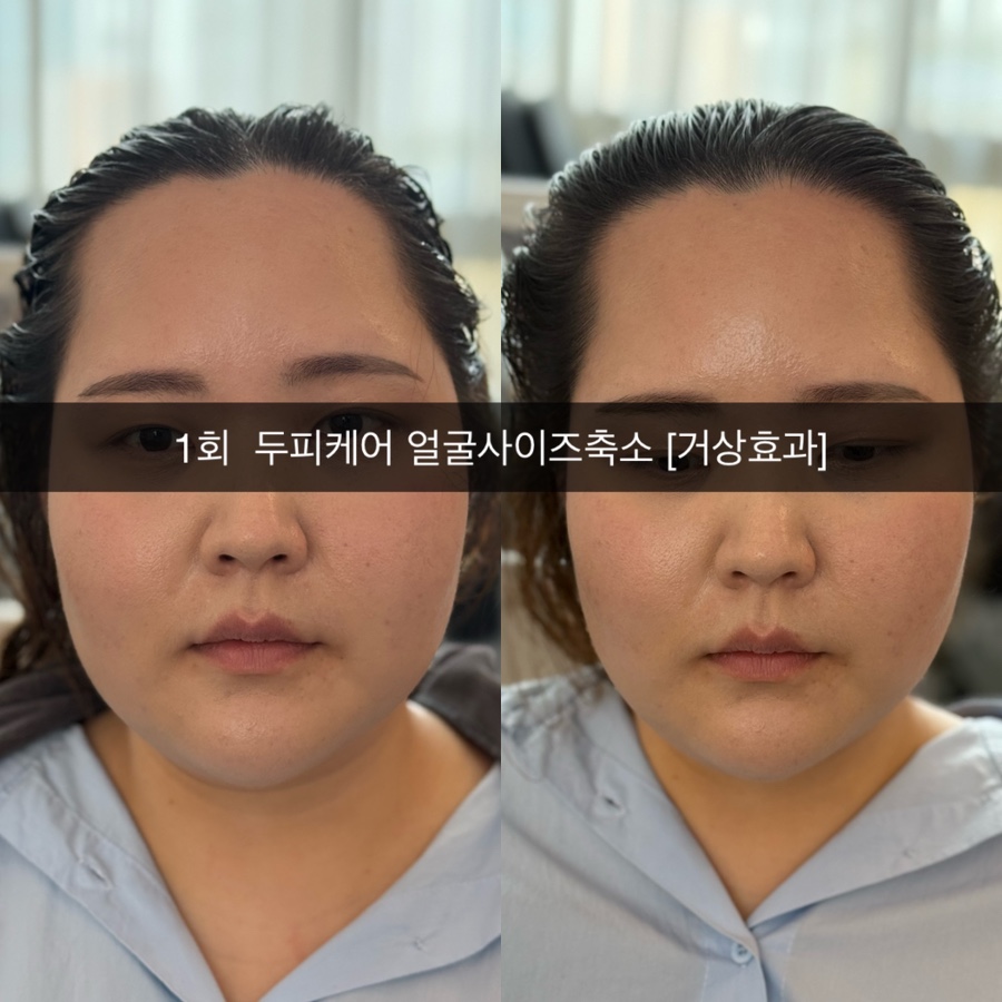 리스칼프 이미지