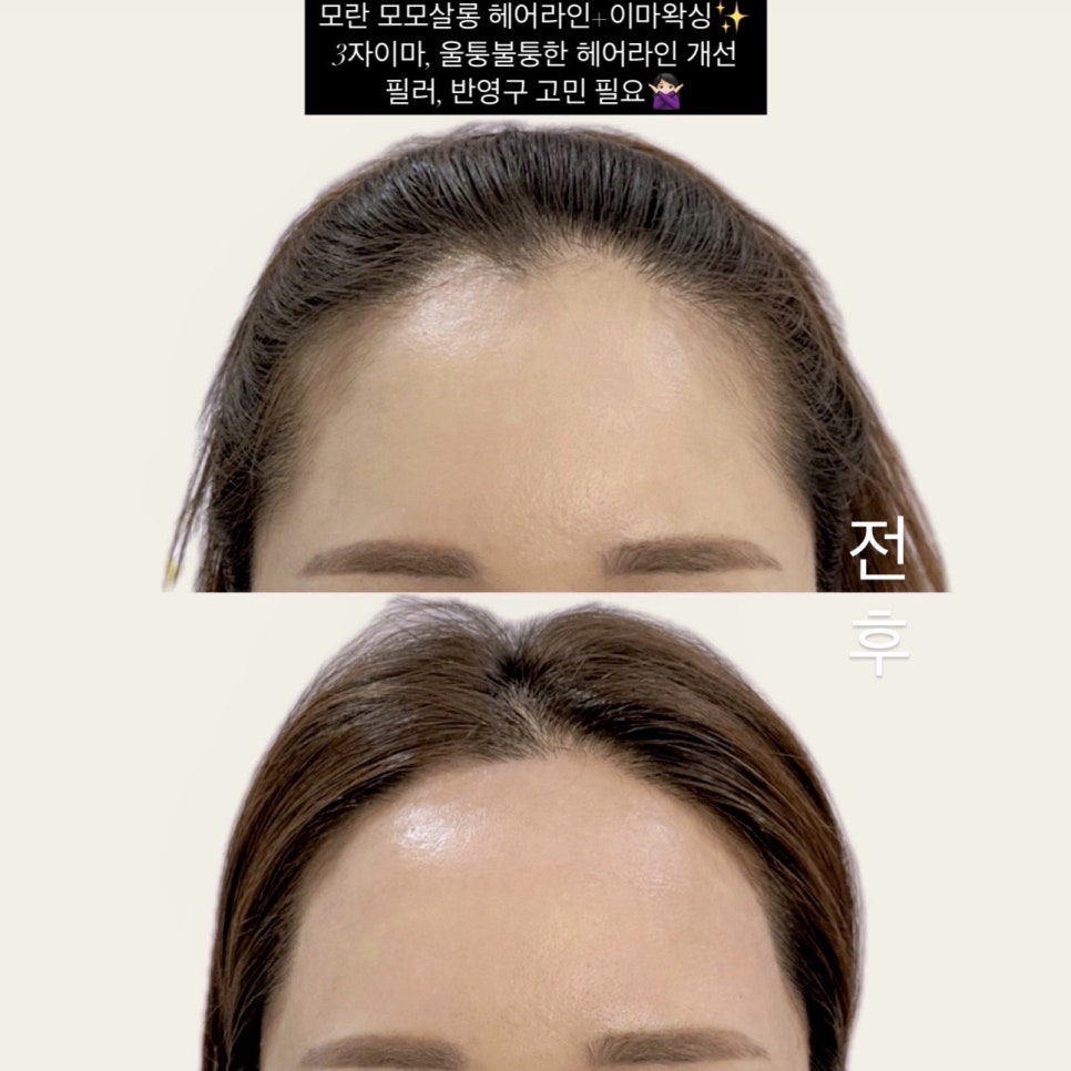 모모헤어라인 이미지