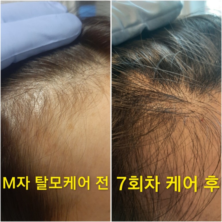 숲칼프가산두피탈모전문센터 이미지