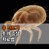 전염성 강한 옴 진드기 초기 증상과 치료법 완치 방법은? : 네이버 블로그