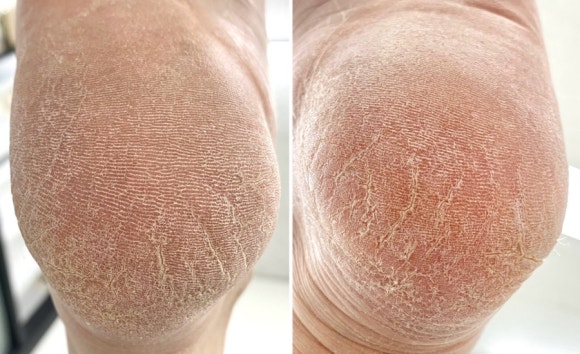 발관리 이미지