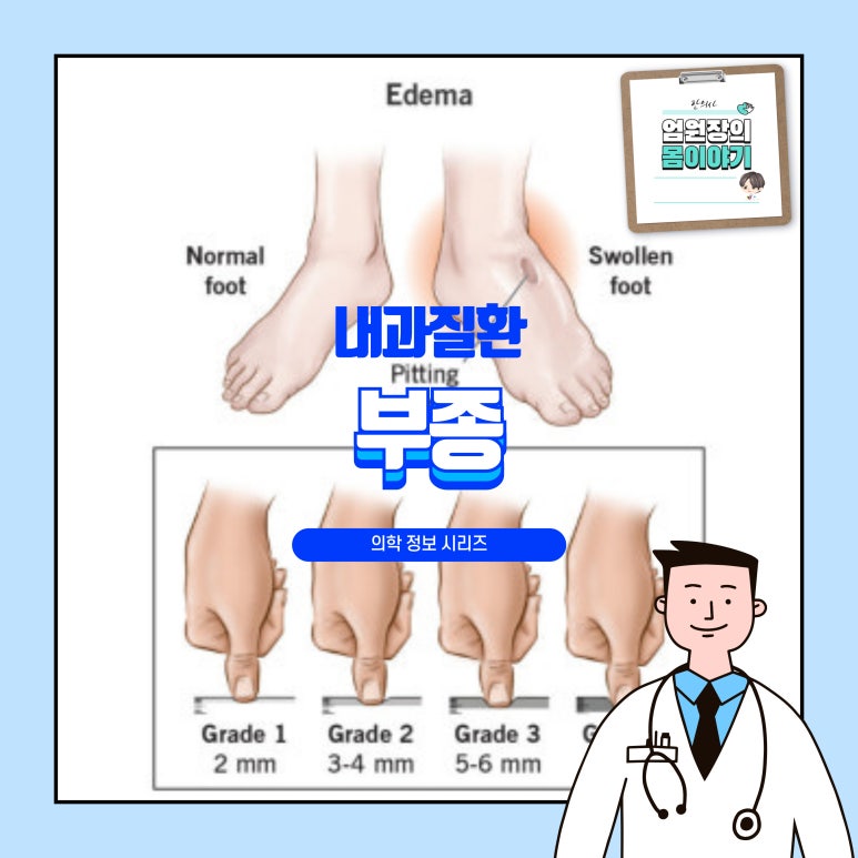 부종의 원인, 증상, 진단, 치료: 손발이 부어요, 몸이 무거워요, 하지부종 [엄원장 내과학 시리즈] : 네이버 블로그