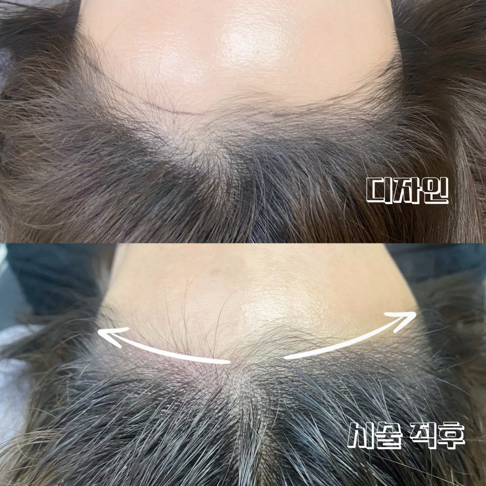 오즈헤어라인 이미지