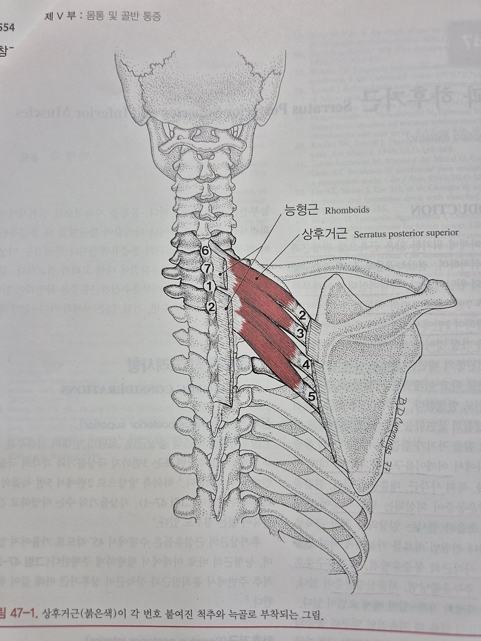 날개뼈 주변의 통증. 상후거근, 전거근, 견갑하근