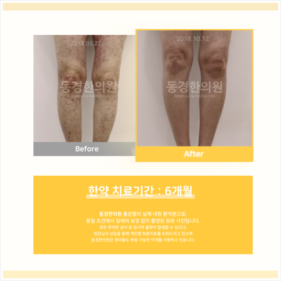장기반점 이미지
