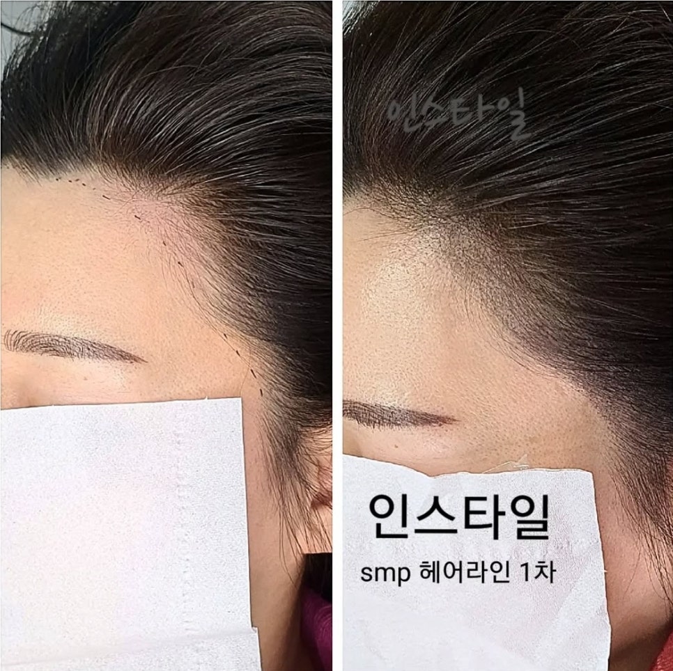 진헤어라인 이미지