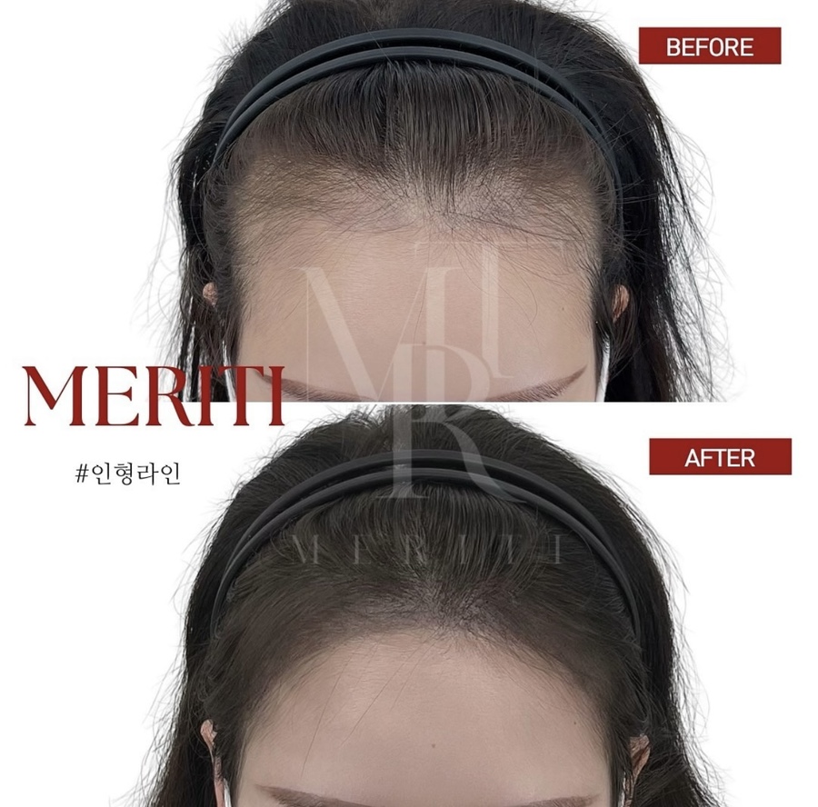 헤어라인 이미지