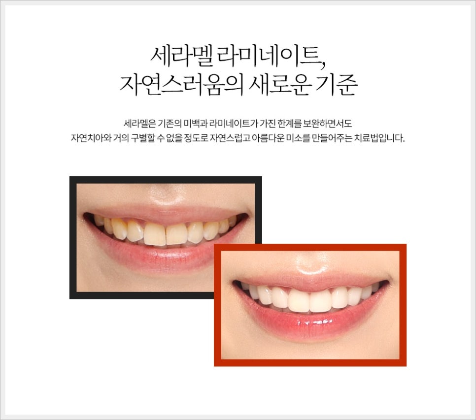 세라덴토 이미지