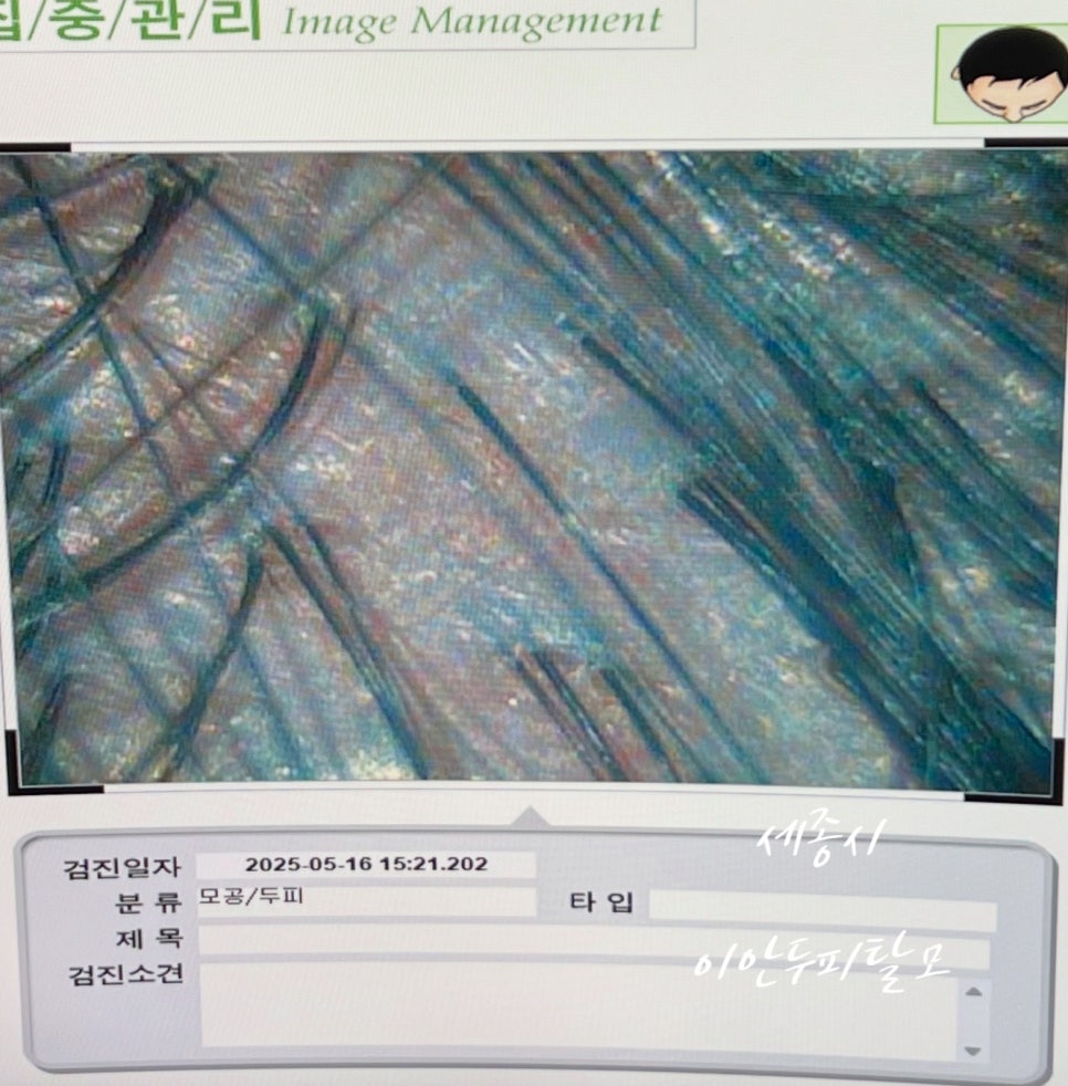 이안두피탈모 이미지