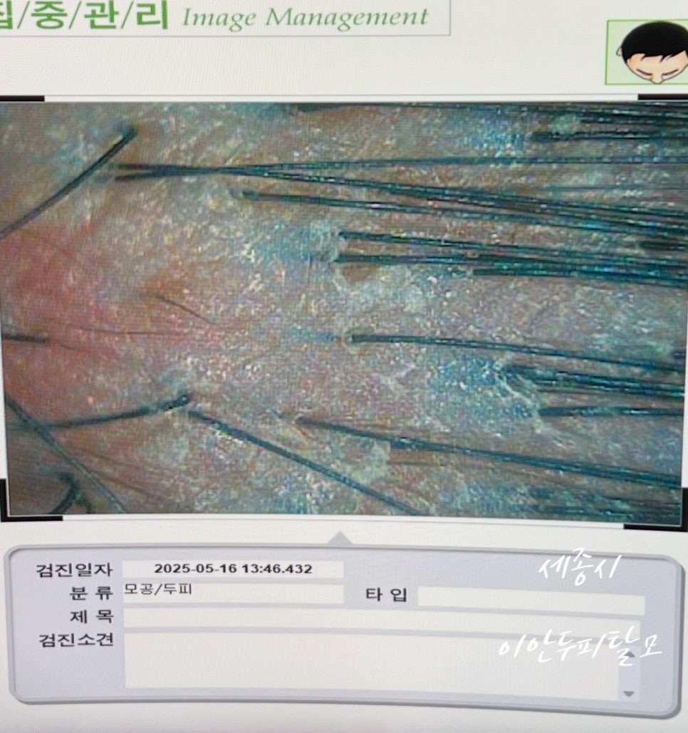 이안두피탈모 이미지