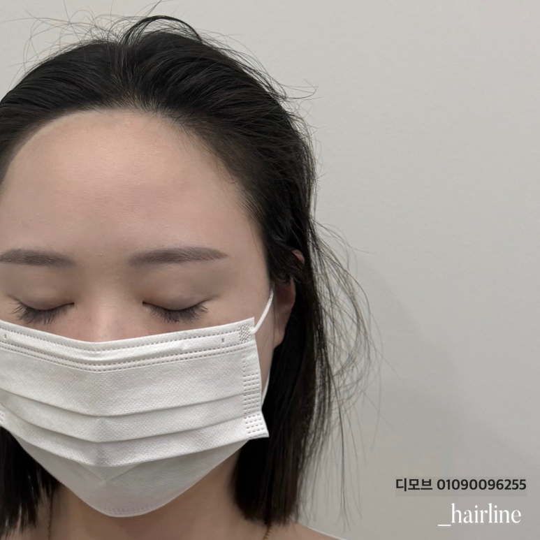 헤어라인 이미지