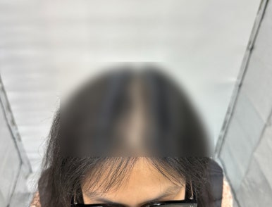 두피움 이미지
