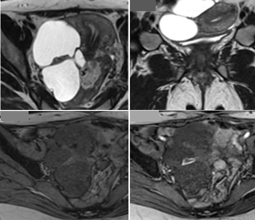 복막포함낭종(Peritoneal Inclusion Cyst): 영상소견과 임상적 접근 : 네이버 블로그