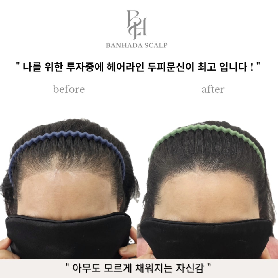 선헤어라인 이미지