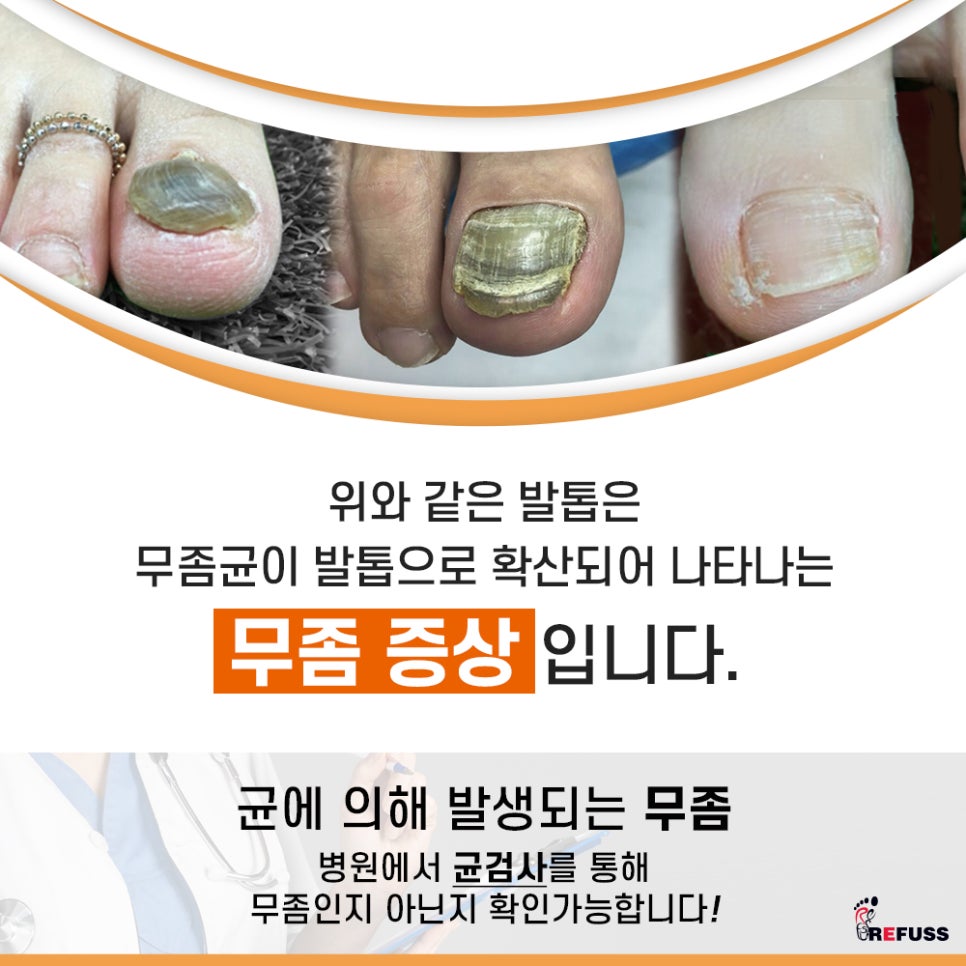 레푸스 이미지