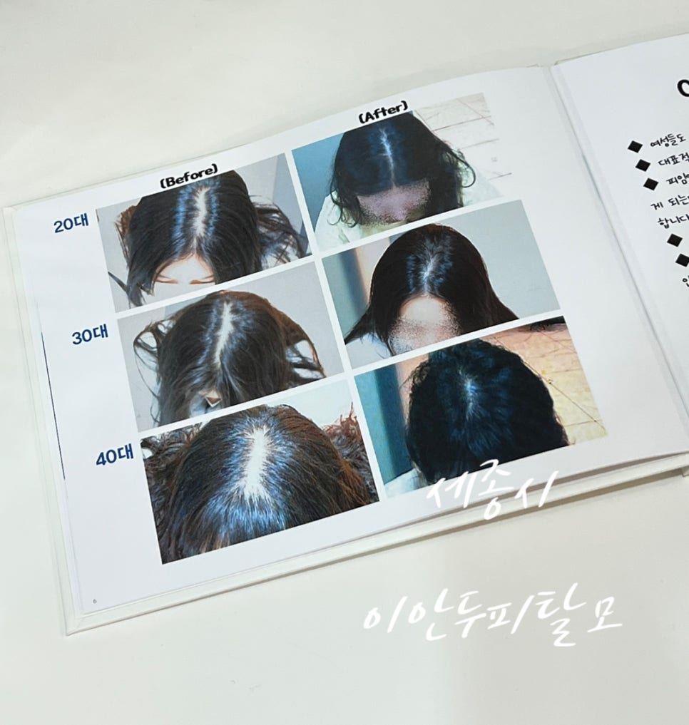 이안두피탈모 이미지