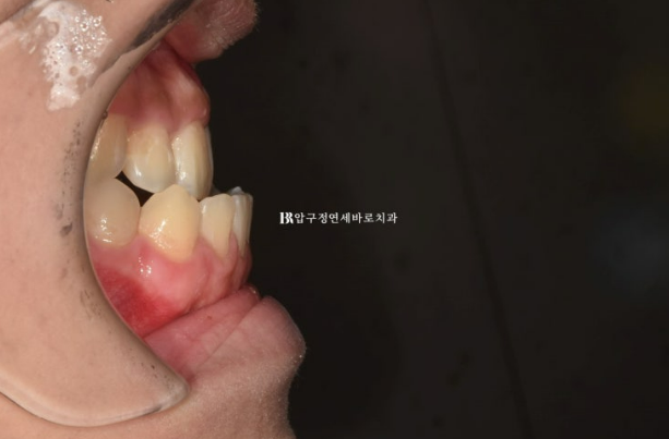 Orthodontic Treatment Review for Prognathism Correction with Invisalign in Orthognathic Surgery image 4