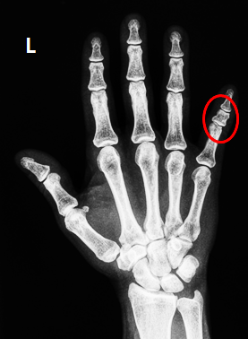 Case Study_971:둔상(Blunt trauma)을 입은 31세 여성-A3형 단지증(Brachydactyly type ...