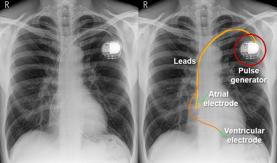 Merlin Box Pacemaker 인공심박동기(Pacemaker) 기본 알기! 정의 및 역할, 구조, 검사/간호/약물 알아보자! : 네이버 블로그