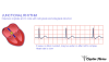 Junctiona Rhytm Junctional rhythm 원인과 EKG 특징 그리고 Junctional rhythm 치료 방법은? : 네이버 블로그
